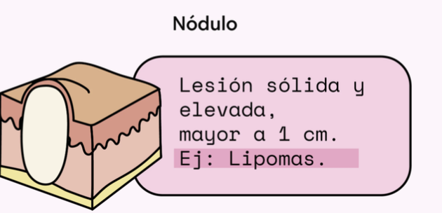 <p>nodulo </p><p>-Lesión elevada y sólida que es</p><p class="p1">mayor a 5mm.</p><p class="p1">-Es de base amplia, bordes definidos</p><p class="p1">Nódulo = “medio círculo”</p><p class="p1">Nodulo blanco → firme a la palpacion</p><p class="p1">Nodulo amarillento → blando a la palpacion</p>