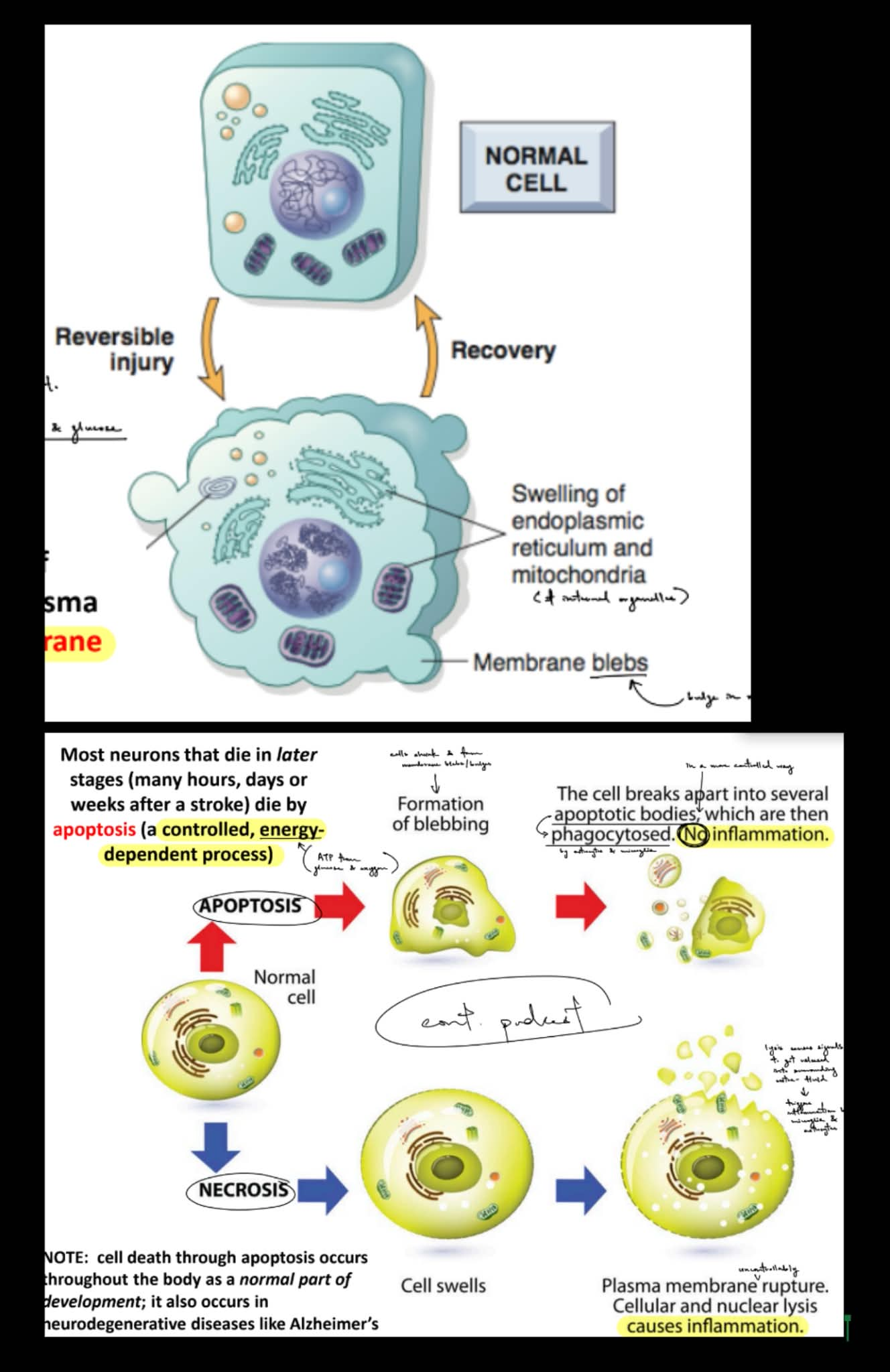 <p>cytotoxic edema is seen as the <u>swelling of organelles</u> &amp; <u>forms </u><strong><u>membrane blebs</u></strong>, which are bulges in the membrane</p><p>cytotoxic edema <strong><u>makes the membrane leaky</u></strong> b/c the neuron <u>loses control of membrane permeability</u> (as seen w/ the membrane bleb)</p><p>__</p><p>if normal cells does apoptosis, then <strong><u>membrane blebs</u></strong><u> will form</u> → then, the <u>cell breaks apart into </u><strong><u>apoptotic bodies</u></strong> that <u>are phagocytosed by microglia &amp; astrocytes</u></p><ul><li><p>apoptosis <strong><u><mark data-color="blue" style="background-color: blue; color: inherit;">does NOT cause inflammation</mark></u></strong></p></li></ul><p>if normal cells does necrosis, then the <u>cell swells</u> → then, the <u>plasma membrane bursts</u> (lysis)</p><ul><li><p><mark data-color="blue" style="background-color: blue; color: inherit;">necrosis </mark><strong><u><mark data-color="blue" style="background-color: blue; color: inherit;">causes inflammation</mark></u></strong></p></li></ul><p>…</p><p>apoptosis is a <u>controlled,</u> <u>energy-dependent</u> process</p><ul><li><p>(^ energy-dependent meaning that apoptosis relies on ATP for energy)</p></li></ul><p>__</p><p>true</p>