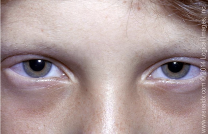 <p>Trichotillomania</p>