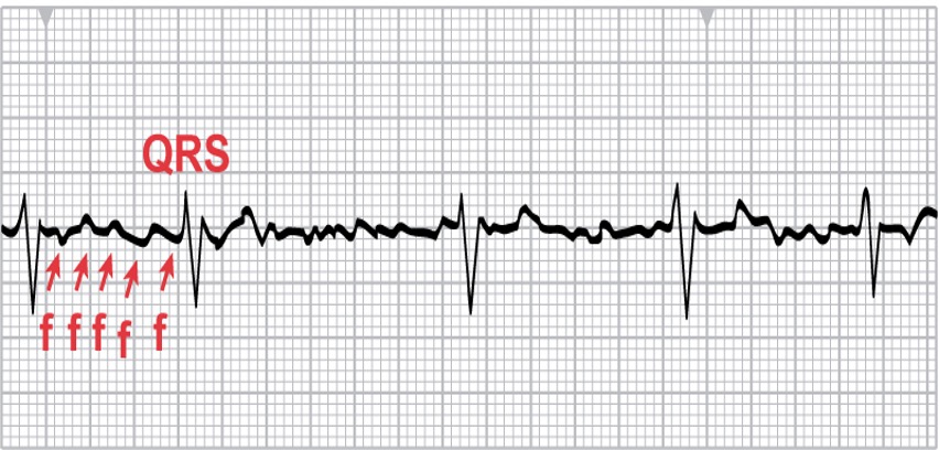 <p>Atrial fibrillation </p><p>-Irregularly irregular — <strong>distance between QRS is irregular</strong> with no identifiable pattern</p><p>-Rate is 350-650 bpm</p><p>-Hallmark <strong>fibrillatory waves</strong></p><p>-<strong>No P waves</strong> visible</p><p></p>