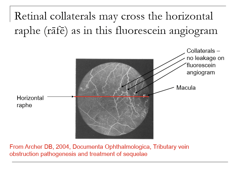 <ul><li><p>Lipid inflitrates after ~2 months</p></li><li><p>Collateral channels open to shunt blood around the occluded zone (can cross horizontal raphe) </p></li><li><p>Venous sheathing</p></li><li><p>Vascular tortuosity </p></li></ul><p></p>