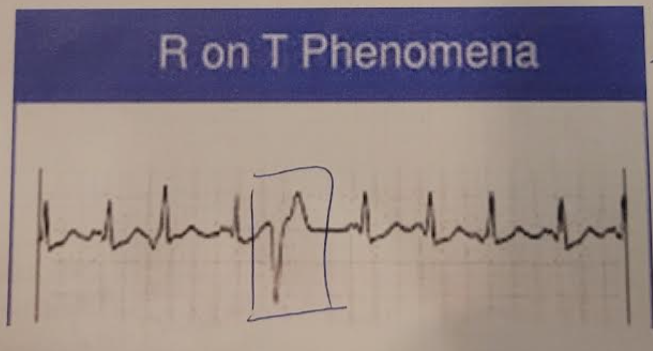 <p>howd yk this was sinus rhythm with unifocal premature ventricular complexes with a rate of 90</p>