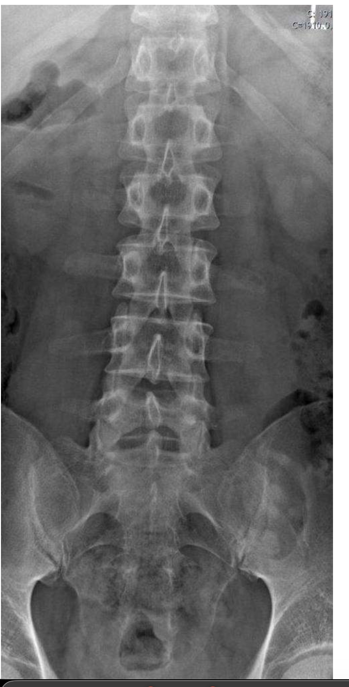 <p>Lumbar; Sacrum</p>