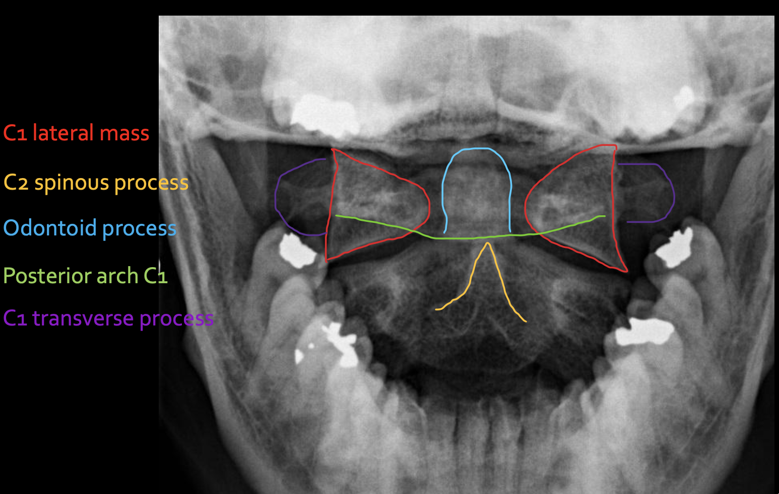 <p><span>C1 lateral mass</span></p>