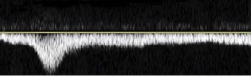 <p>This augmentation is considered _____.</p>