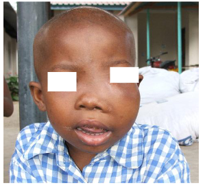 <p>2. Burkitt Lymphoma</p>