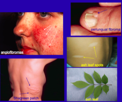 <p>Skin lesions: Adenoma sebaceum. Ash-leaf spots. Brain lesions: Subependymal hamartomas. Cortical tubers. Subependymal giant cell astrocytomas located at foramina of Monro (May lead to hydrocephalus)</p>