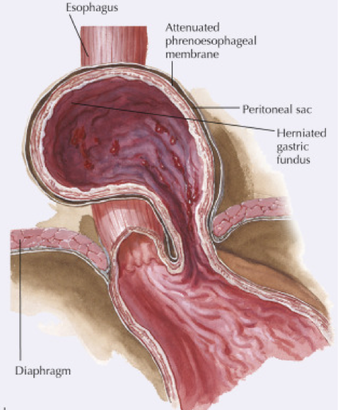 <p>This rarer type of hiatal hernia involves the gastric fundus herniating alongside — not in line with — the esophagus.</p>
