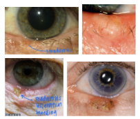 <p>What is the most likely diagnosis ?</p>