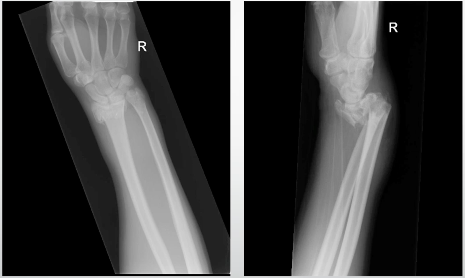 <p>radius tilts anteriorly when fractured</p>