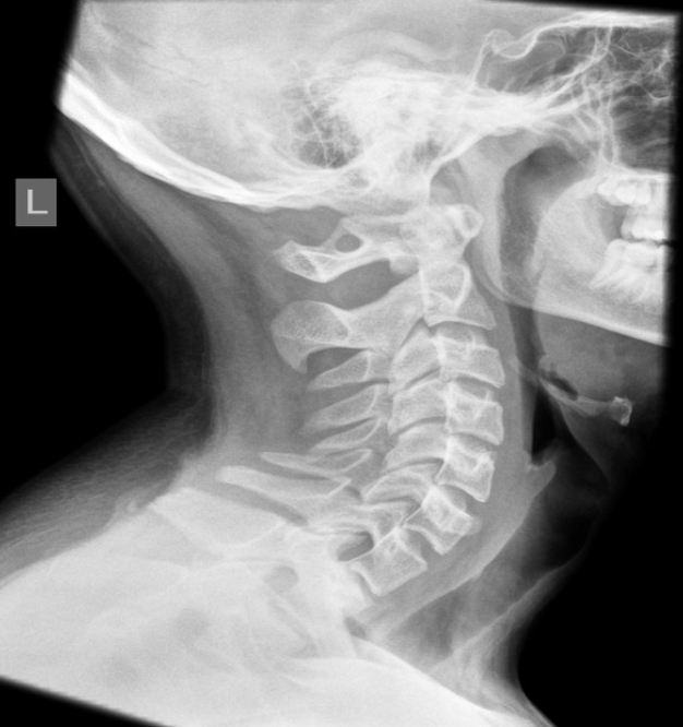 <p>Arcuate foramen form when atlanto-occipital ligaments calcifies; transmits the sub-occipital nerve and the vertebral artery </p>