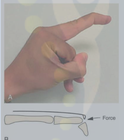 <p>Mallet finger</p>