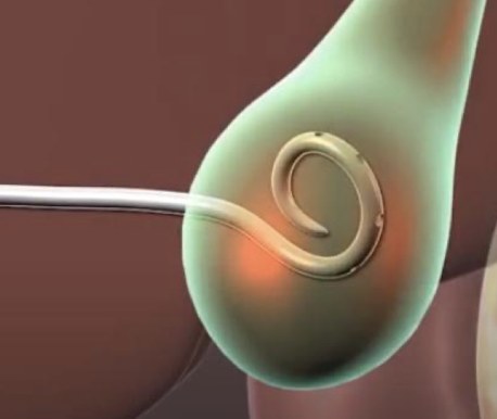 <ul><li><p>large abscesses or persistent fluid collections may require a percutaneous drainage catheter to remain in place for continuous drainage</p></li><li><p><span style="color: yellow;">pigtail catheter </span>is MC type</p></li><li><p>the catheter is…</p><ul><li><p>connected to a collection bulb or drainage canister</p></li><li><p>sutured to the skin (to keep it secure)</p></li></ul></li></ul><p></p>