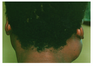 <p>1.what is this lesion?</p><p>2. how to treat/ manage it?</p><p>3. classification of oral lesion in HIV?</p>