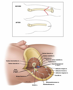 <ul><li><p>“Fish mouth” incision</p></li><li><p>Myopexy of posteromedial musculature to shape stump</p></li><li><p>Scar line sits at the base of the stump</p></li><li><p>Also referred to as “Above Knee Amputation” (AKA)</p></li></ul><p></p>