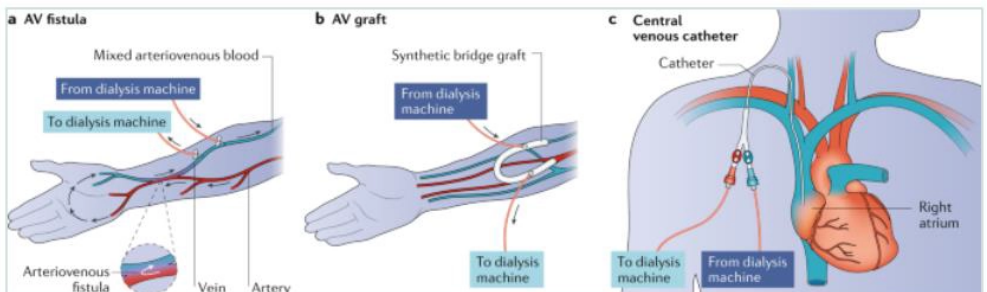<ul><li><p>AV fistula</p></li><li><p>AV graft</p></li><li><p>central venous catheter</p></li></ul><p></p>