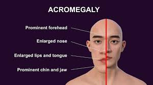 <ul><li><p>results from too much growth hormone after epiphyseal plates close</p></li><li><p>bones don’t grow longer but instead <strong>thicker</strong></p></li><li><p>bones of face, hands, jaw</p></li></ul><p></p>