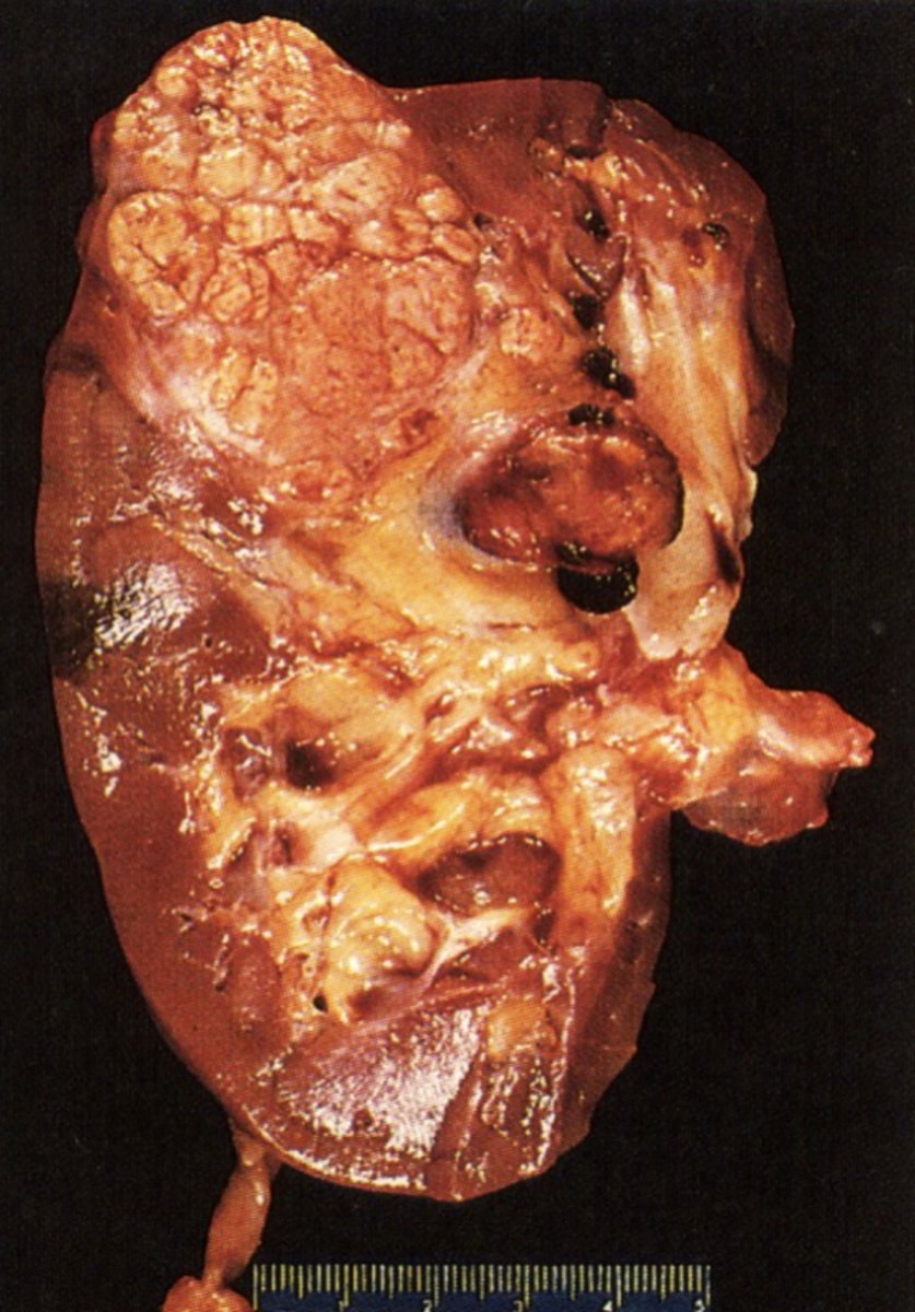 <p>Increased glycogen</p>