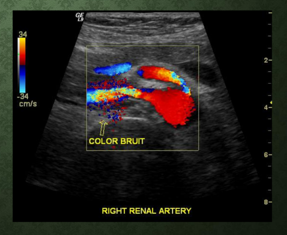 <p>DIRECT METHOD INTERPRETATION GIVE ME THE VALUES </p><p>what is the criteria for stenosis % and the following are criteria for the stenosis</p><p>RAR</p><p>PSV</p><p>you will see what post to a stenosis </p><p>color _____</p><p>Damping of what arteries </p><p>AI </p><p>AT</p>