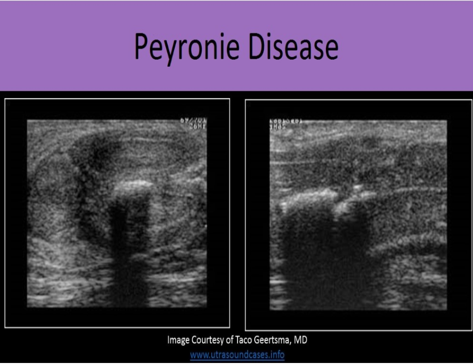 <p>A. Peyronie disease</p><p>Peyronie Disease is the development of scar tissue and fibrous plaque formation that usually involves the tunica albuginea. It causes restriction and curvature of the affected side of the penis during erection and can be very painful. 2D imaging demonstrates hyperechoic areas along the outer margins of the corpus cavernosa.</p>