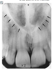 <p>Radiolucent area above maxillary incisors</p>