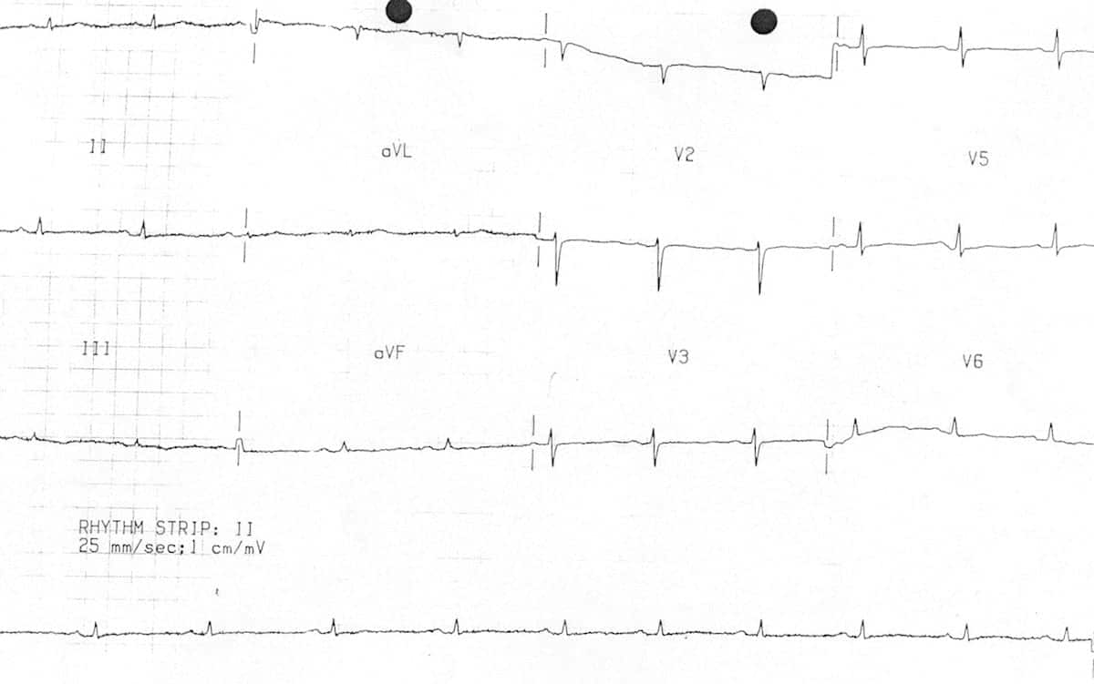 <p>A 68 y/o woman with a history of amyloidosis presents with progressive fatigue, dyspnea on exertion, and lower extremity edema. Physical examination reveals jugular venous distention, hepatomegaly, and bilateral pitting edema. Lungs are CTA. Echocardiogram shows normal ventricular size and preserved ejection fraction with impaired ventricular filling and biatrial enlargement. What is the most likely diagnosis? </p>