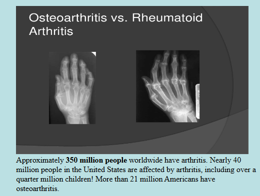 <p>Joint Diseases + Adult vs Child Skeleton</p>