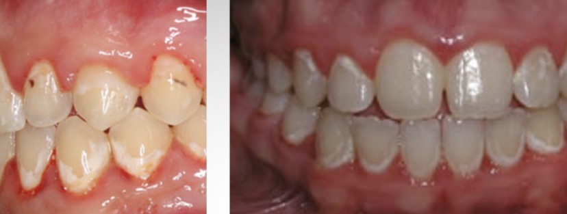 <p><span><span>Enamel Decalcification</span></span></p>