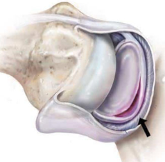 <p><span style="background-color: transparent;"><strong>What is the name of the injury shown in the picture below?</strong></span></p>