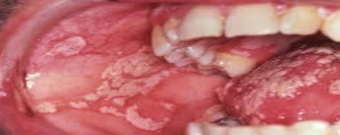 <p>• Name of lesion:</p><p>• Causative organism:</p><p>• Describe the lesion:</p>
