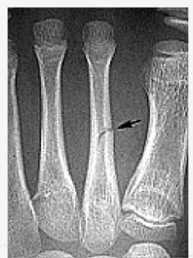 <p>what type of fracture?</p>