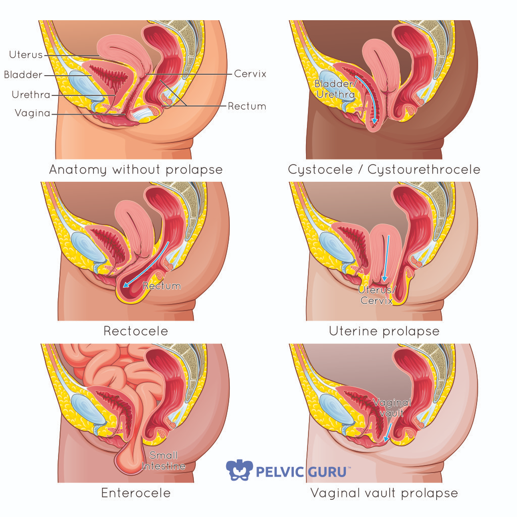 <p>Enterocele</p>