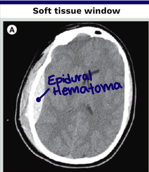 <p>Soft tissues such as brain gray and white matter</p>