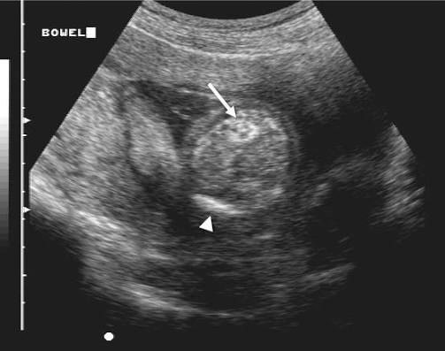 <p>dilated ileum filled with echogenic material </p><ul><li><p>often associated with cystic firbrosis</p></li></ul><p></p>
