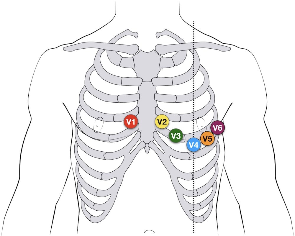 <p>which of the following is the correct placement of lead V4?</p><p>A: fourth intercostal space at the left of the sternum </p><p>B: Fifth intercostal space at the midclavicular line </p><p>C: Fifth intercostal space at the midaxillary line </p><p>D: Fourth intercostal space at the right of the sternum</p>