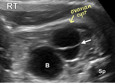 <ul><li><p>ovarian cyst that results from maternal hormonal stimulation</p></li><li><p>usually benign</p></li><li><p>typically represent normal functional ovarian cysts</p></li><li><p>MC cystic mass in female fetuses</p></li><li><p>can be unilateral or bilateral</p></li><li><p>most regress in utero or postnatally</p></li><li><p>have the potential to lead to ovarian torsion or rupture </p></li></ul><p></p>