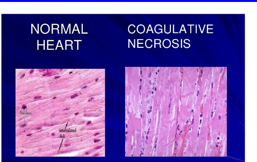 <p>What is <span><strong>Coagulative necrosis? </strong></span></p>