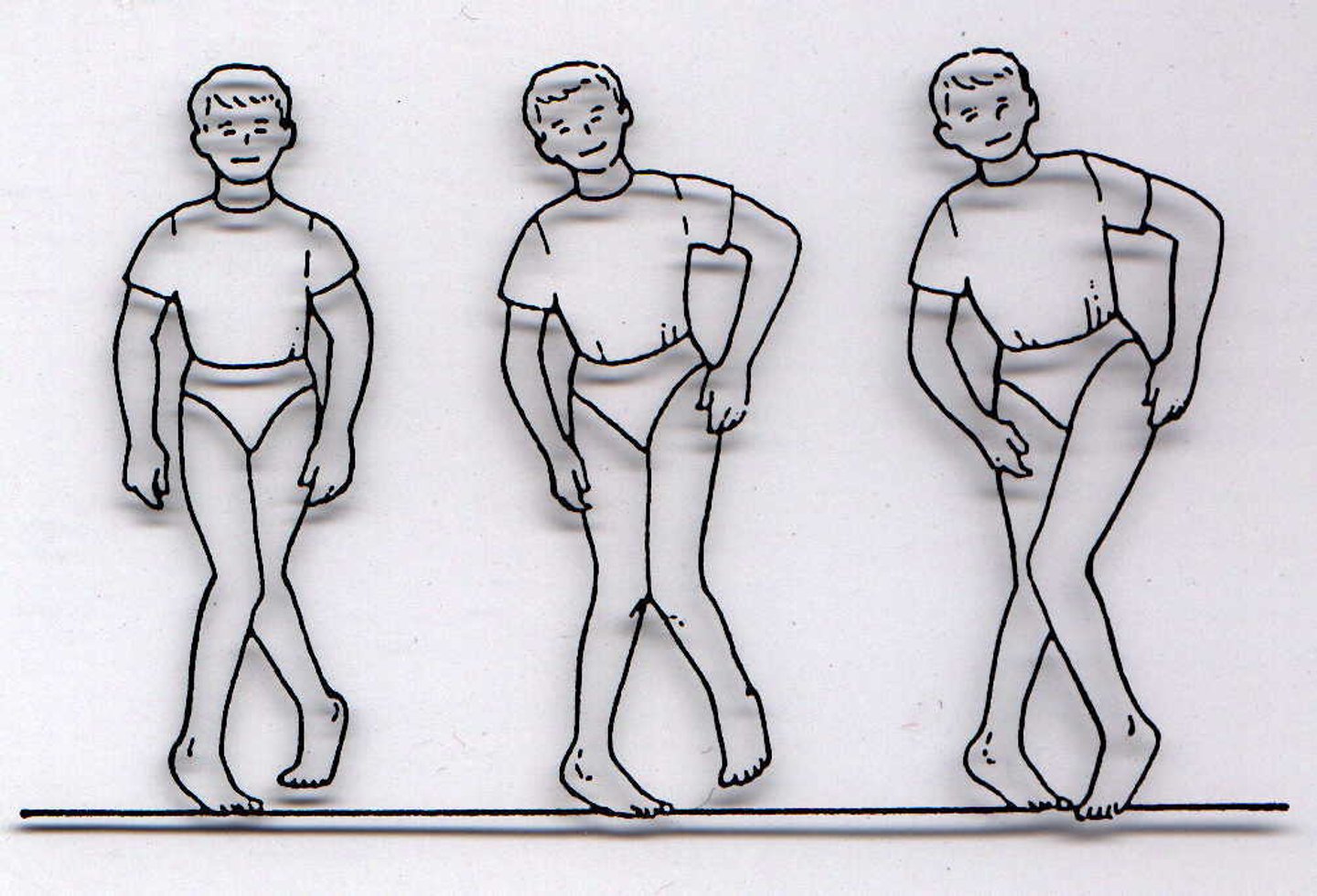 <p>seen in spastic CP; internal rotation of feet, legs walking on top of each other (hip adductors are tight)</p>