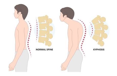 <p>An exaggerated thoracic curve, often resulting in a rounded upper back.</p>