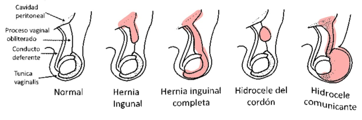 <p>Patología del <strong>conducto del peritoneo vaginal (CPV)</strong> en la edad pediátrica. Motivo de consulta más frecuente por patología quirúrgica pediátrica y el de mayor numero de intervenciones.</p><ul><li><p>Conducto peritoneo vaginal se desarrollo durante el 3° mes de la gestación como una prolongación del peritoneo parietal a través del anillo inguinal profundo.</p></li><li><p>Evaginación del peritoneo a través del canal inguinal, función de facilitar el pasaje del testículo en su trayecto desde el retroperitoneo hacia las bolsas. (3° mes y culmina 7° mes de vida intrauterina)</p></li></ul><p></p>