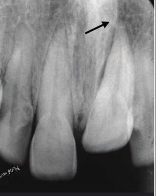 <p>-can crush neurovascular bundle</p><p>-wait ~2-3 weeks to re-erupt</p><p>-get ortho consult right away in case re-eruption does not occur</p>