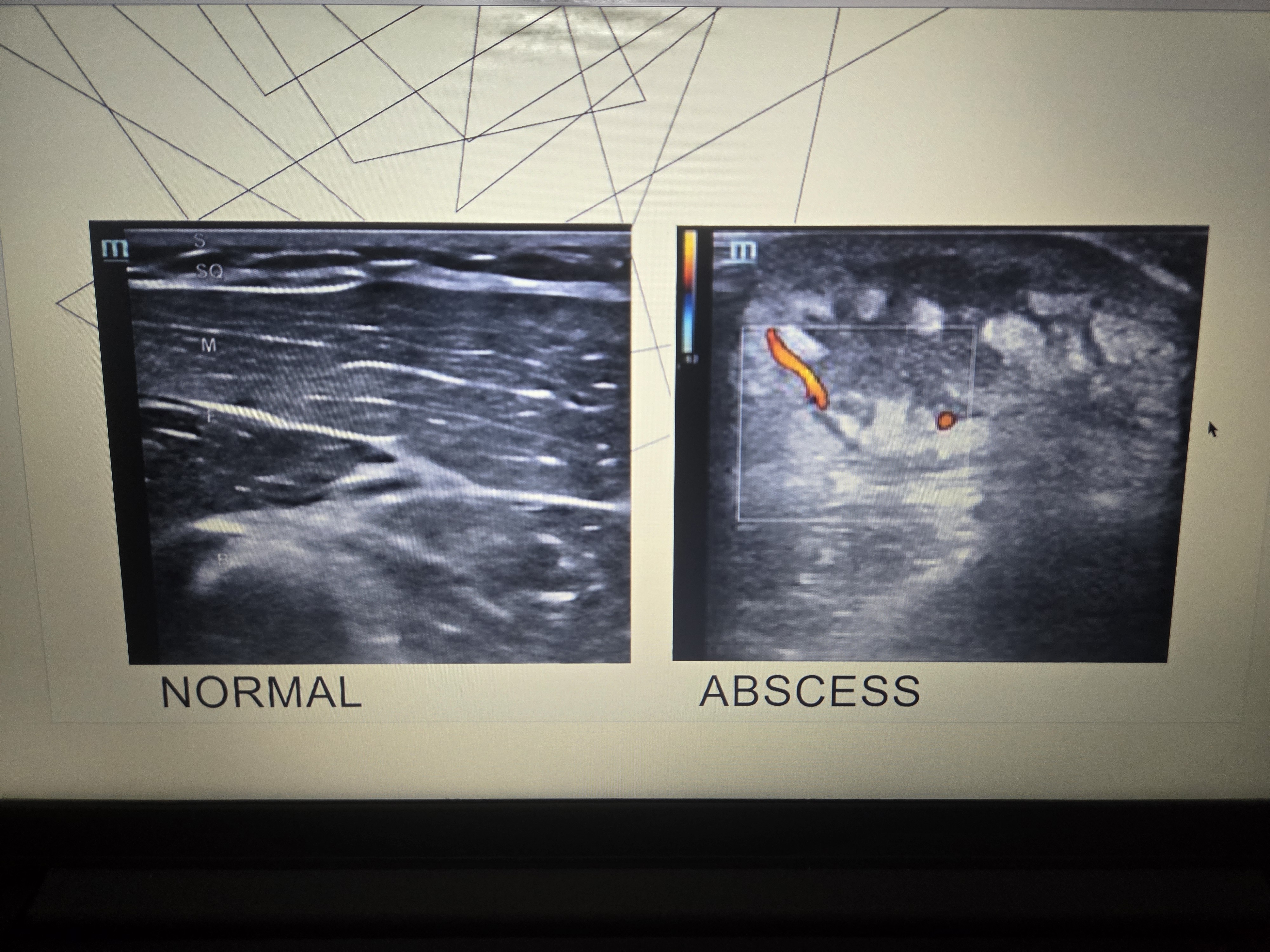 <p>POCUS Abscess</p>