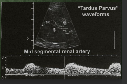 <p>Abnormal - >60% stenosis MRA</p><p>• Reduced color flow in kidney unilaterally</p><p>• Loss of ESP (early systolic peak) – flattened systolic upslope</p><p>• Dampened waveform</p><p>• Prolonged AT - >0.07</p><p>• Tardus parvus waveform</p><p>• Low amplitude, prolonged</p><p>rise time, rounding of</p><p>waveform</p>