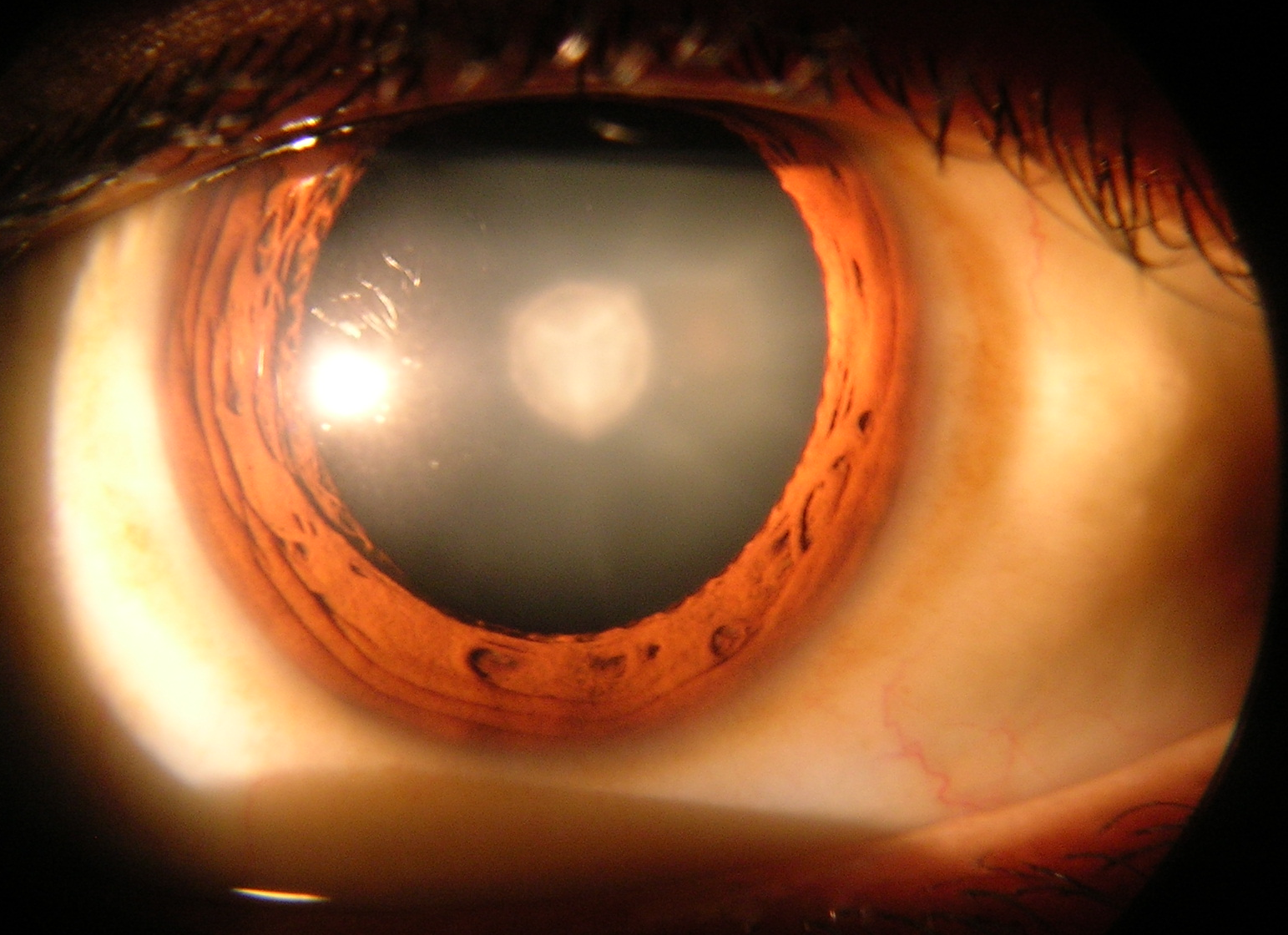 <p>opacity of lens that develops with aging and gradually obstructs vision </p>