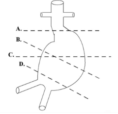 <p>Which of the following shows the correct plane for measuring the diameter of this aortic aneurysm?</p><p>a. a </p><p>b. b</p><p>c. c</p><p>d. d</p><p>e. both b and c are correct</p>