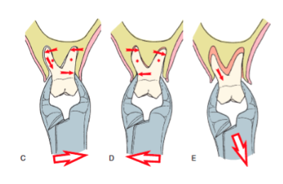 <p>• Apical pressure is used to expand the socket</p><p>• Bucco-lingual motion (mostly buccal) is used to expand the socket</p><p>• Figure 8 movement can be used to continue expanding the socket</p>