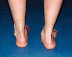 <p>heel of foot</p>