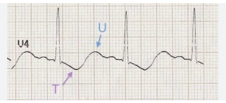 <p>U waves</p>
