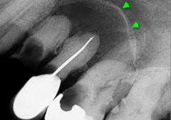 <p>describe the effect of the lesion:</p>