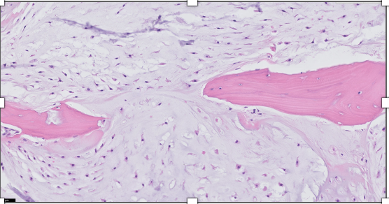 <p>Homme de 50 ans, lésion lytique dans la diaphyse du fémur </p><p>diagnostic</p><p>définition</p><p>age</p><p>topographie</p><p>anatomie</p><p>histologie</p><p>IHC moléculaire</p>